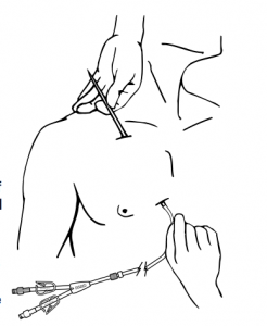 Insertion of the Hickman catheter