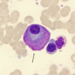 Multiple myeloma flame shaped plasma cell