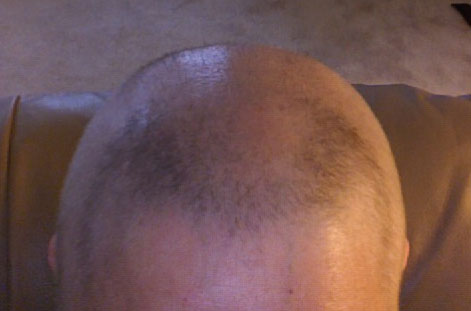 Hair growing back after stem cell transplant