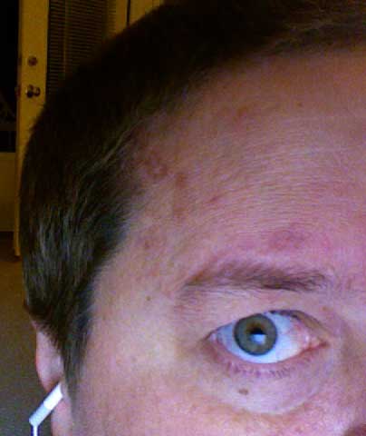 The shingles on my head - getting better